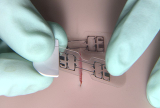 The microMend device being applied. (Image: KitoTech Medical)